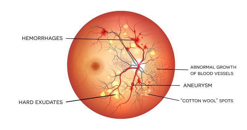 Explanation of diabetic retinopathy