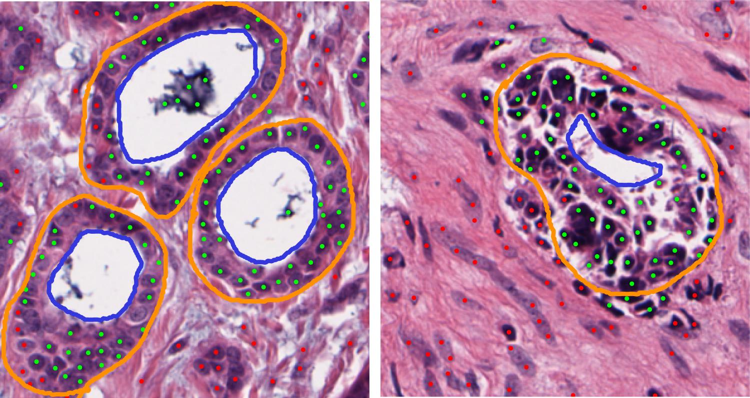 breast cancer deep learning thesis