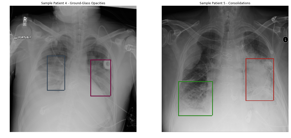 Pneumonia Detection from chest radiograph (CXR) · Intelec AI Blog