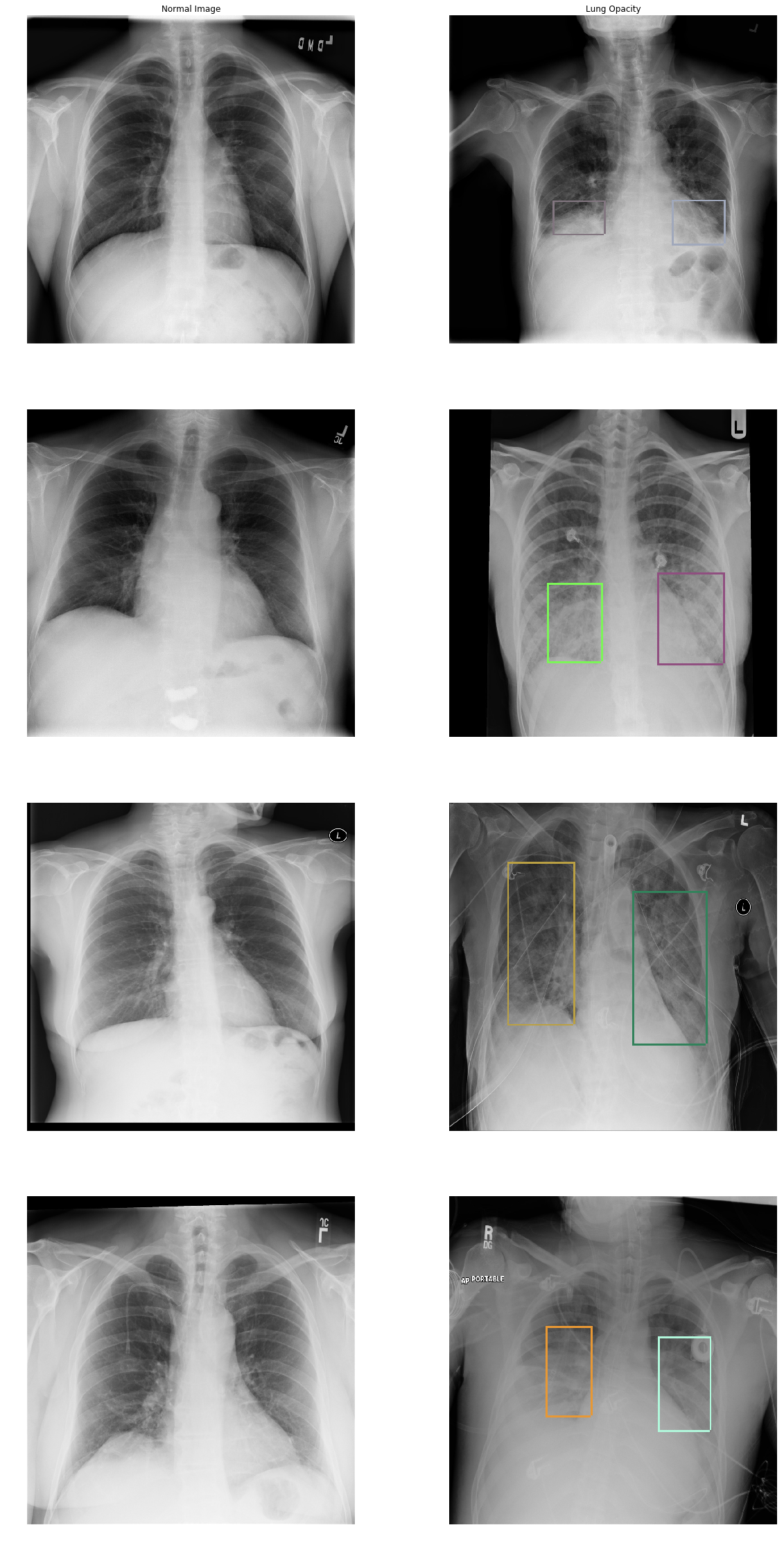 Normal vs Lung Opacity image